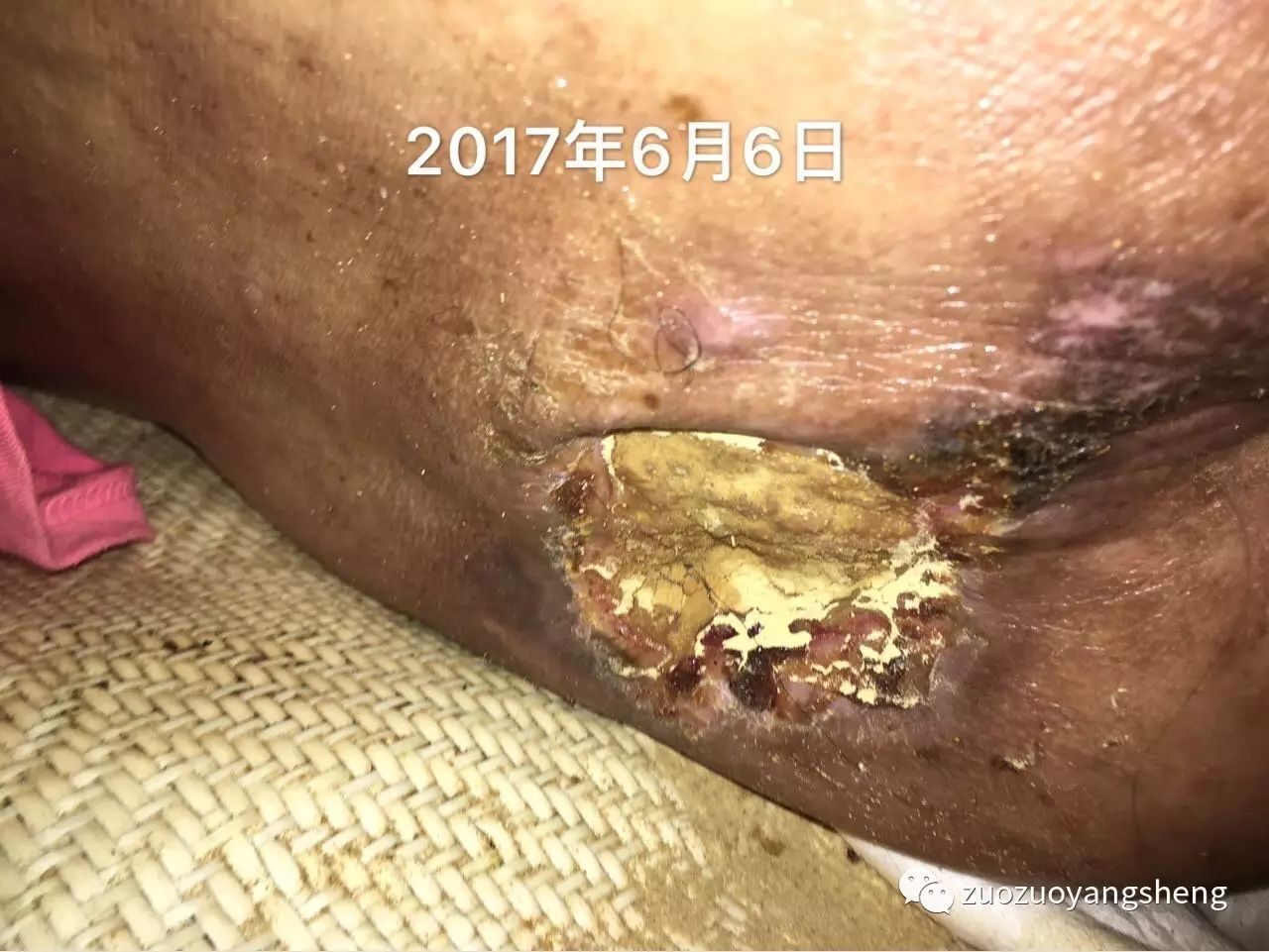 案例分享：原始点调理病危老人的案例