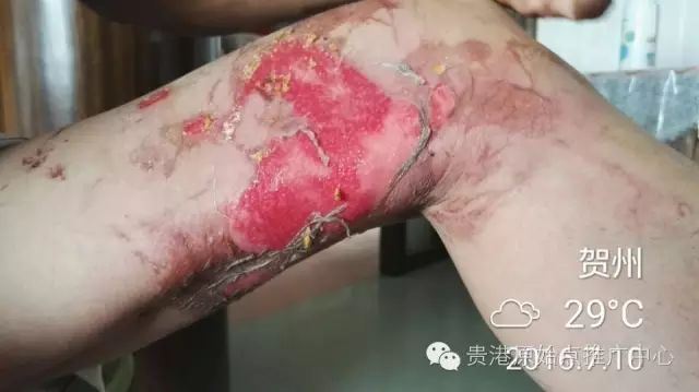 案例分享:原始点调理车祸烧伤不留疤的案例 案例分享:原始点调理车祸烧伤不留疤的案例