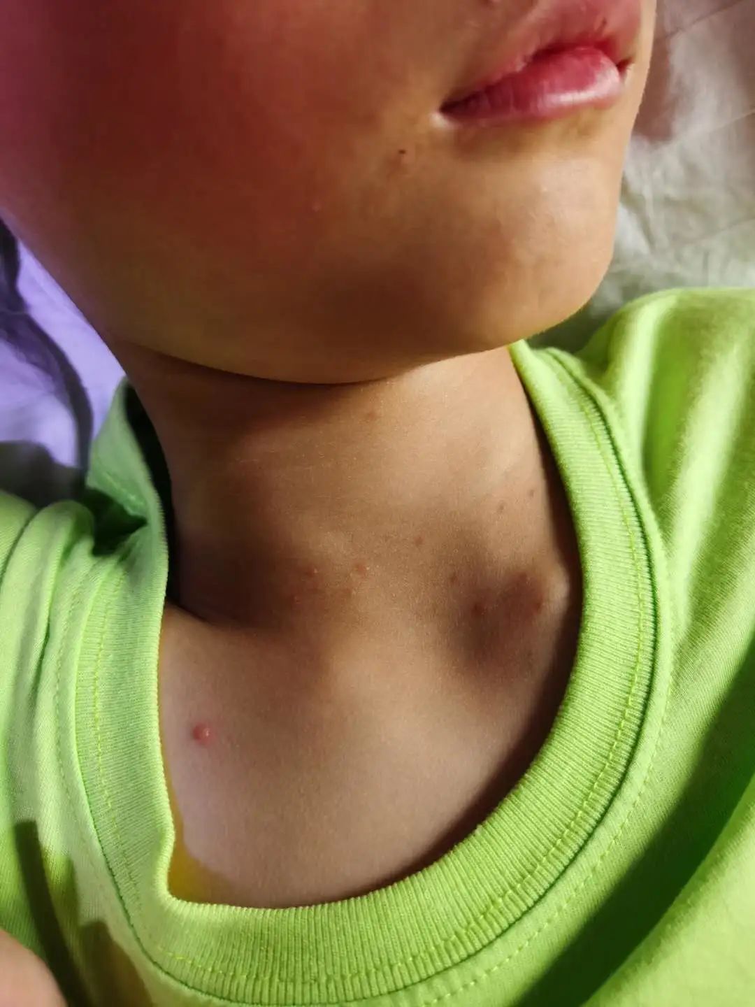 案例分享:原始点调理孩子水痘案例 案例分享:原始点调理孩子水痘案例