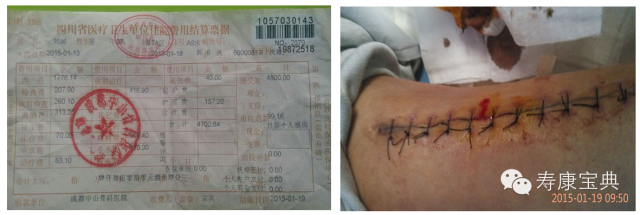 案例分享:原始点调理骨折手术后的恢复 案例分享:原始点调理骨折手术后的恢复