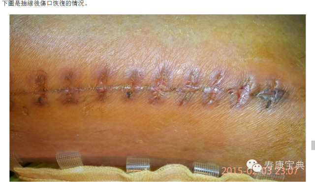 案例分享:原始点调理骨折手术后的恢复 案例分享:原始点调理骨折手术后的恢复