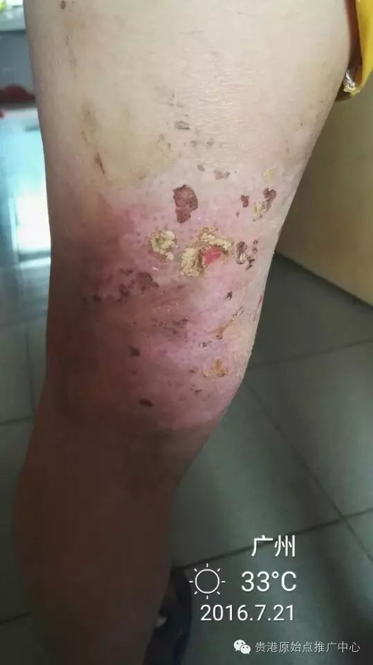 案例分享:原始点调理车祸烧伤不留疤的案例 案例分享:原始点调理车祸烧伤不留疤的案例