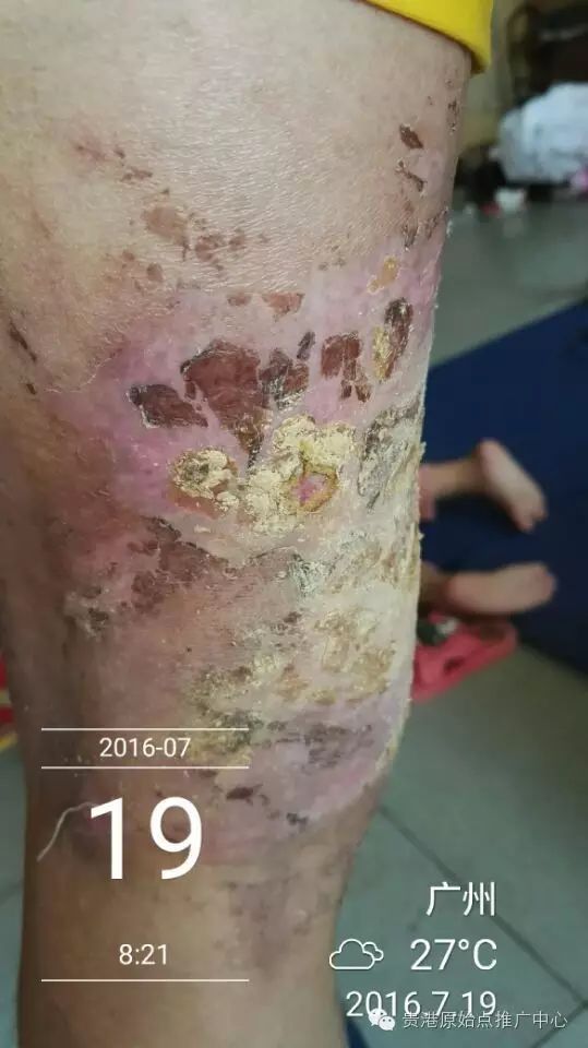 案例分享:原始点调理车祸烧伤不留疤的案例 案例分享:原始点调理车祸烧伤不留疤的案例