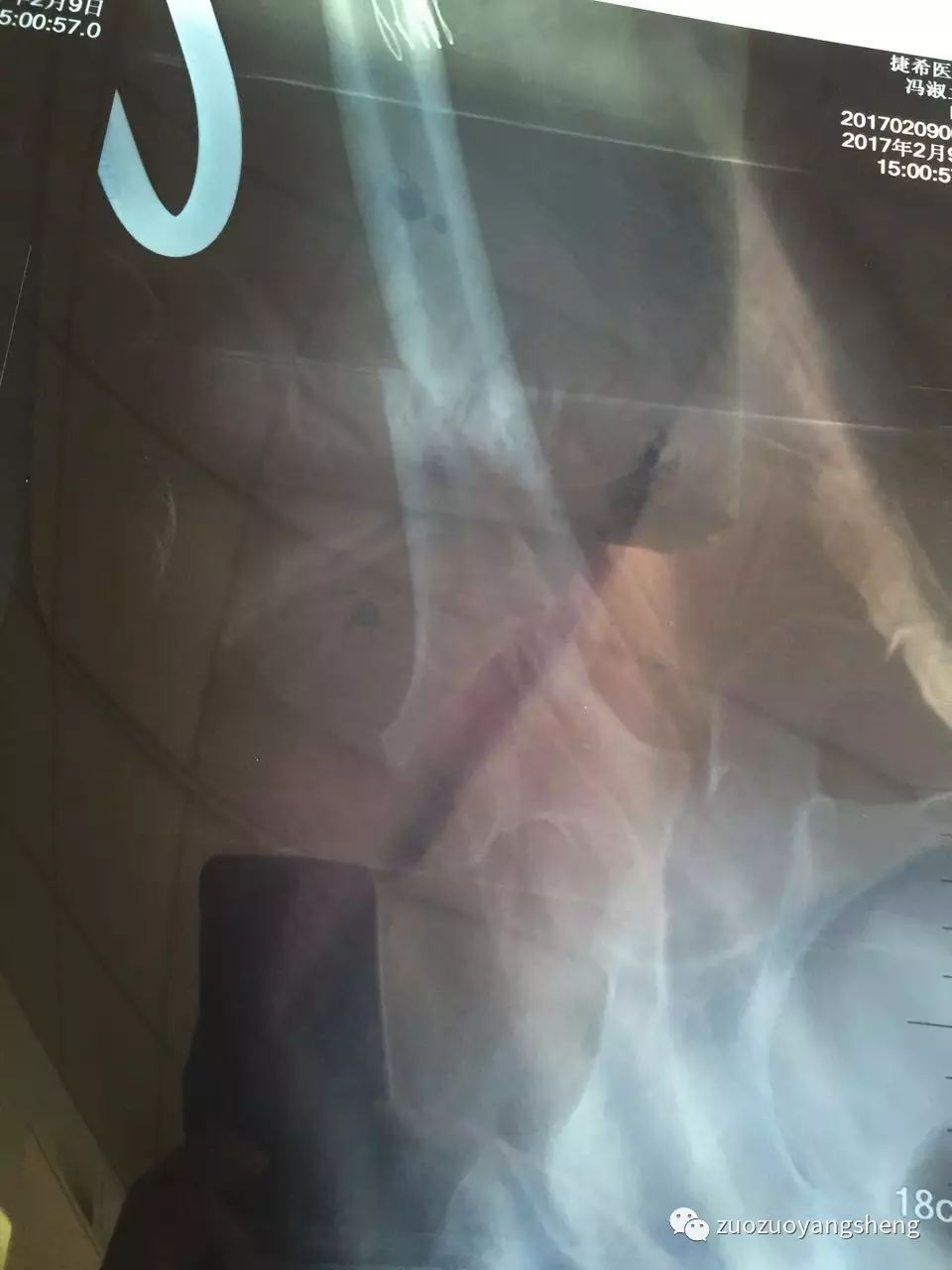 原始点续写又一奇迹：83岁婆婆骨折错位没开刀没手术，6周康复