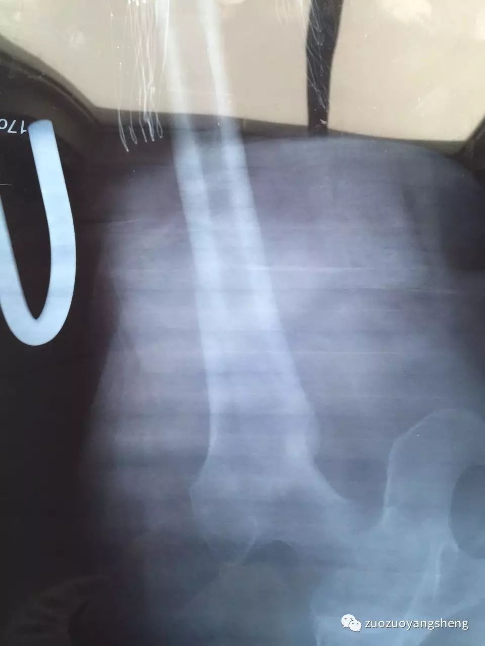 原始点续写又一奇迹：83岁婆婆骨折错位没开刀没手术，6周康复