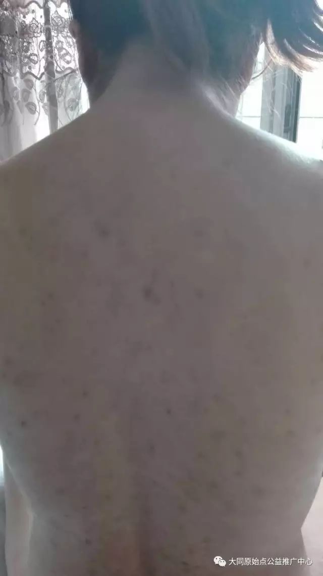 案例分享:原始点调理孕妇全身玫瑰藓的案例 案例分享:原始点调理孕妇全身玫瑰藓的案例
