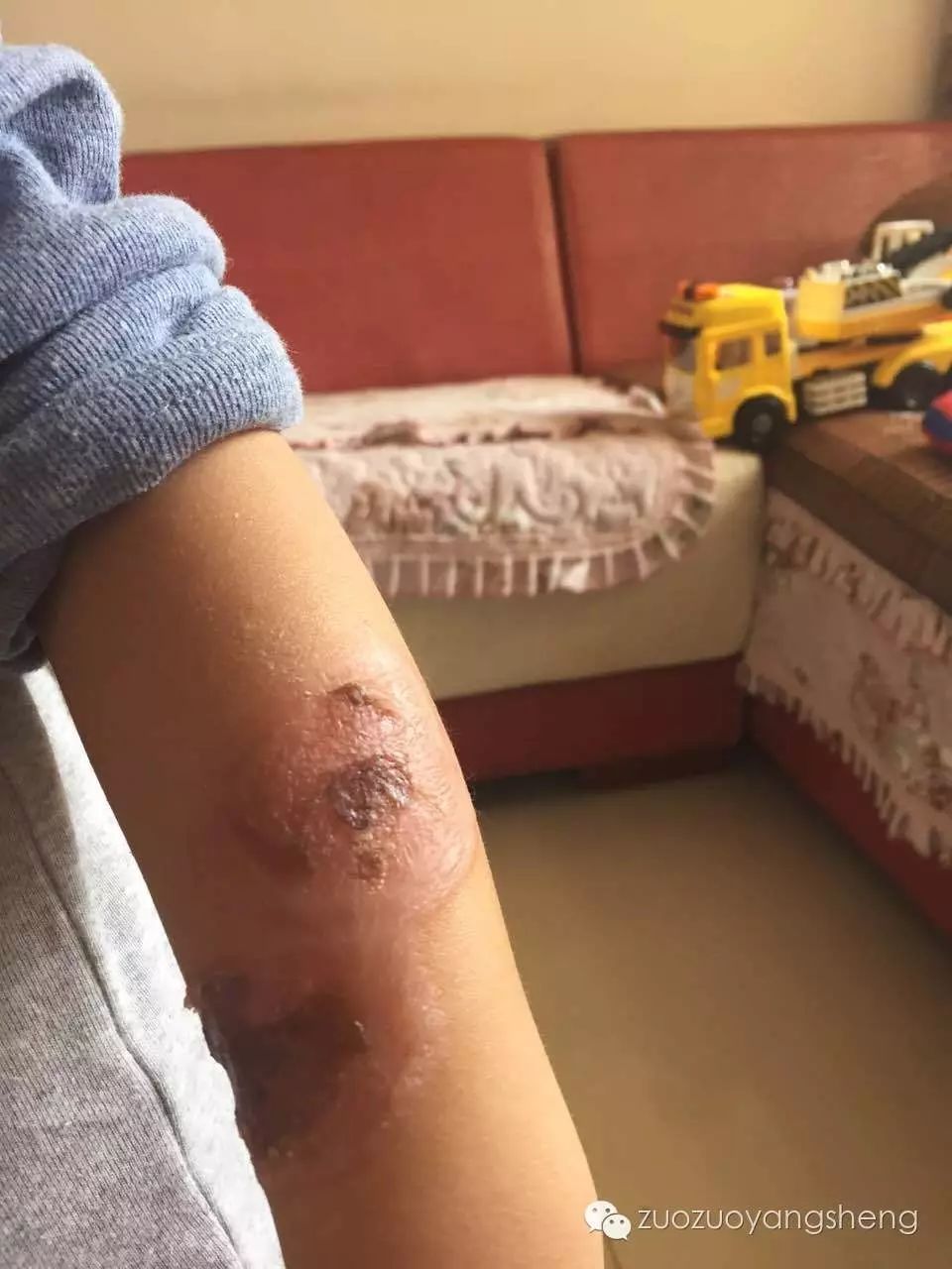 案例分享：温敷的奇迹——原始点调理带状疱疹的案例-原始点全球同学网