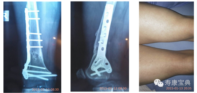 案例分享:原始点调理骨折手术后的恢复 案例分享:原始点调理骨折手术后的恢复