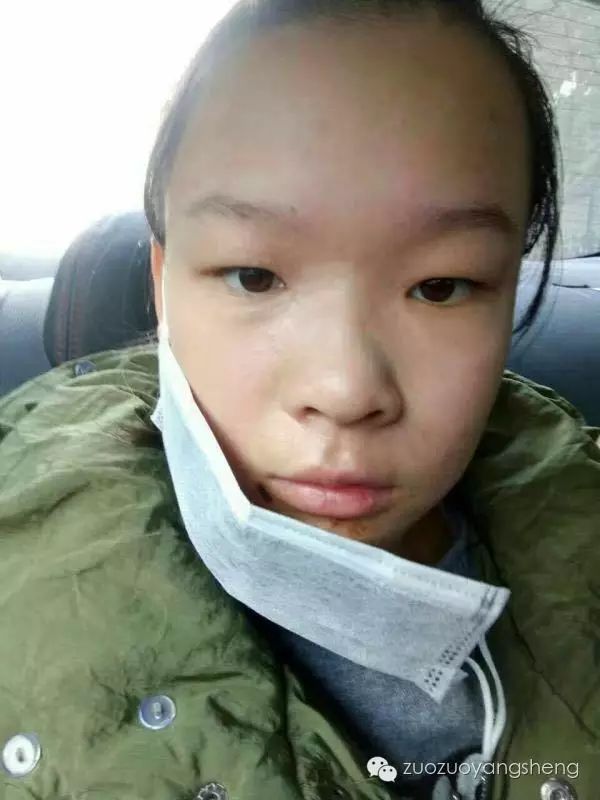 案例分享:原始点调理花季少女面部烫伤不留疤的案例 案例分享:原始点调理花季少女面部烫伤不留疤的案例