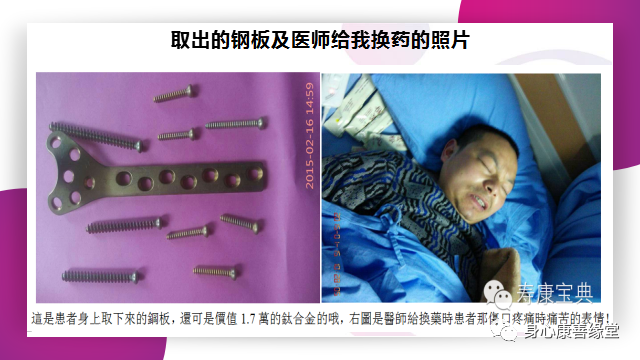 原始點:腿伤术后康复记 原始點:腿伤术后康复记