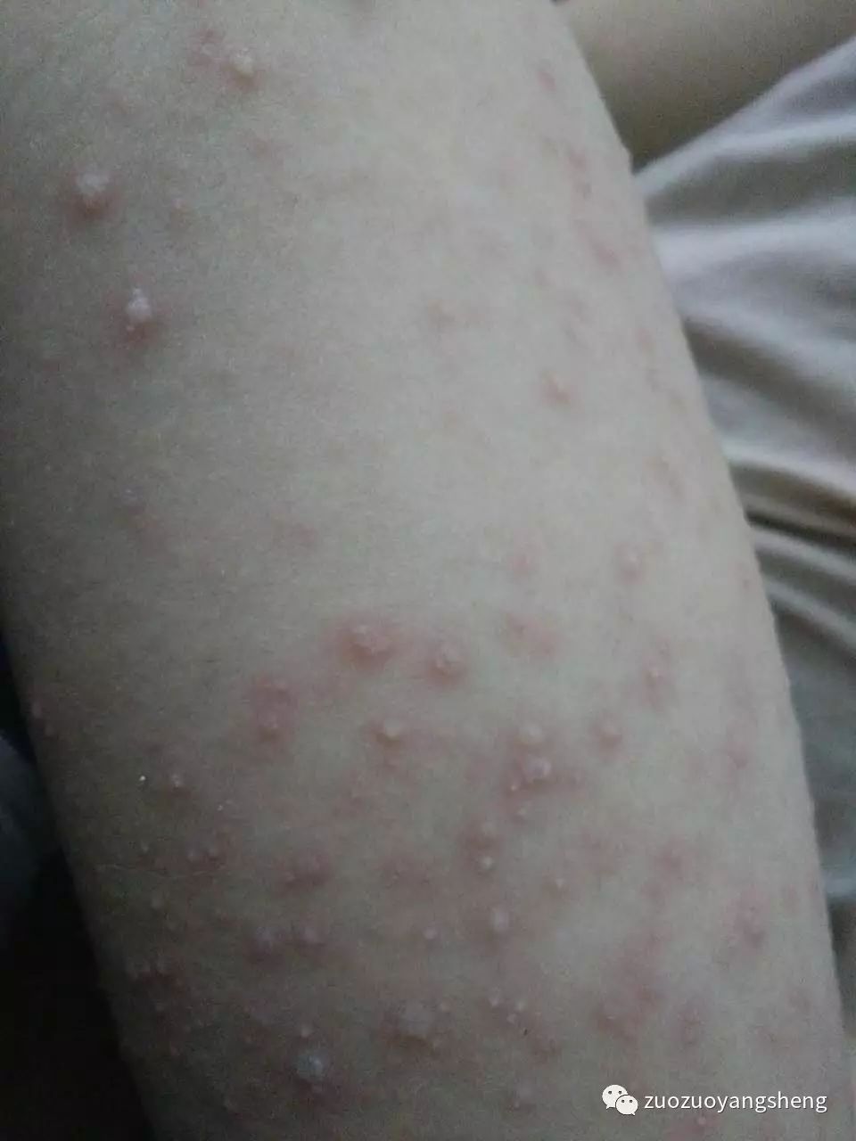 原始点调理幼儿咳嗽后出现严重好转反应