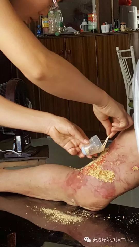 案例分享:原始点调理车祸烧伤不留疤的案例 案例分享:原始点调理车祸烧伤不留疤的案例