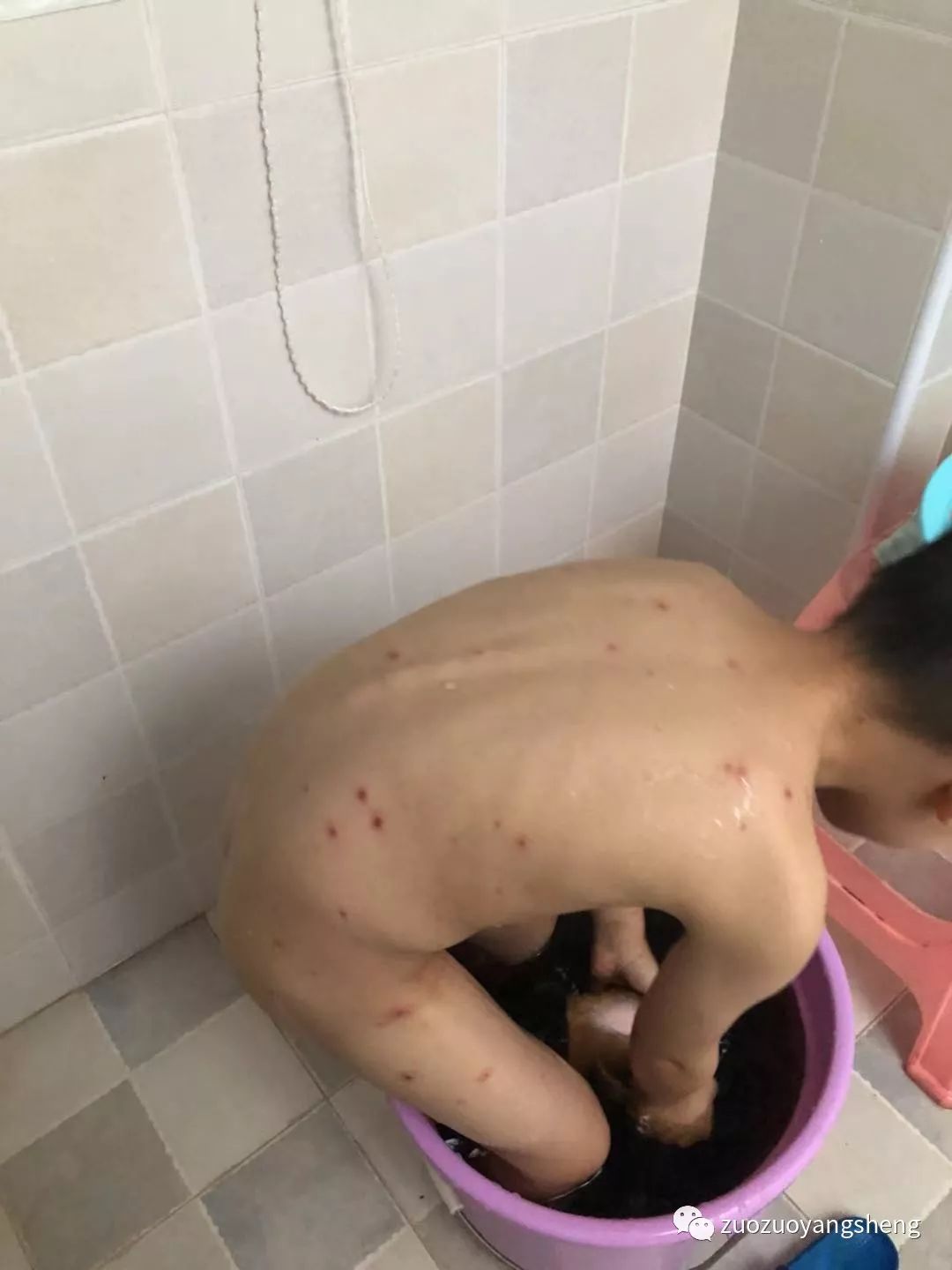 案例分享:原始点调理五岁小孩长水痘案例 案例分享:原始点调理五岁小孩长水痘案例