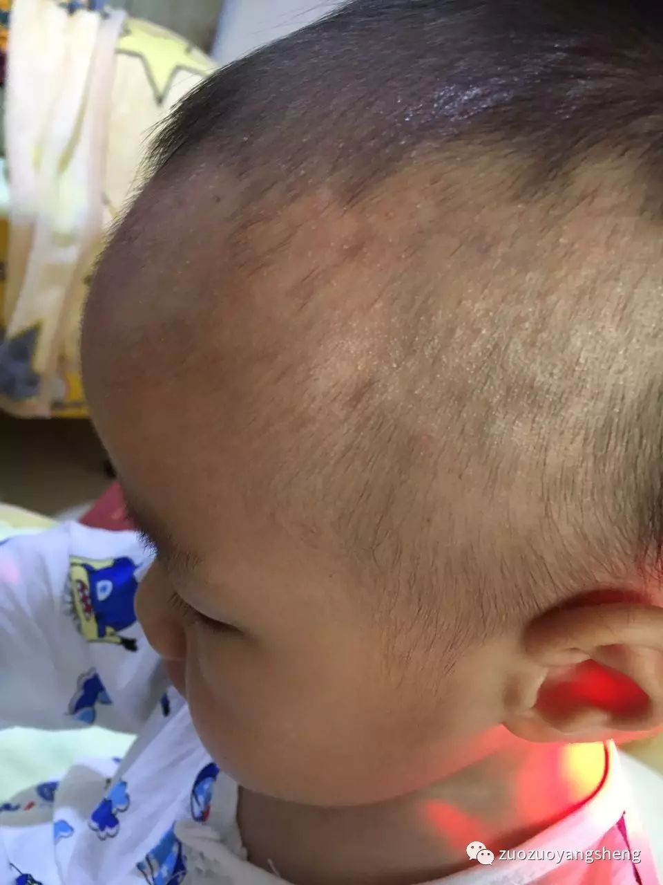 原始点调理幼儿咳嗽后出现严重好转反应