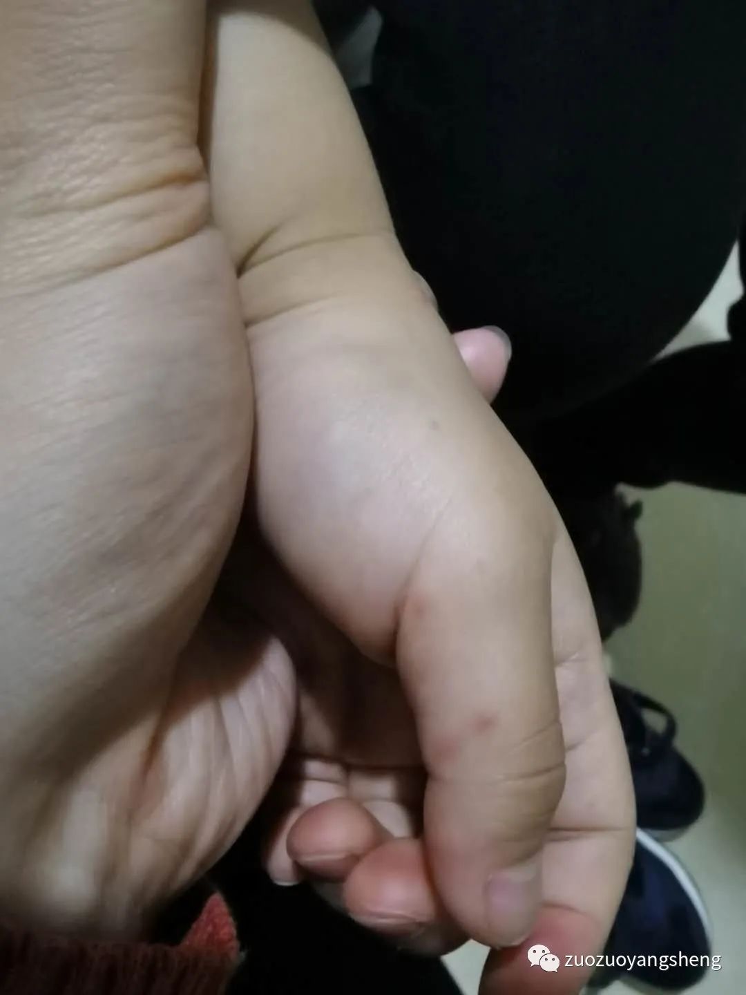 案例分享:原始点调理儿童手足口病的案例 案例分享:原始点调理儿童手足口病的案例