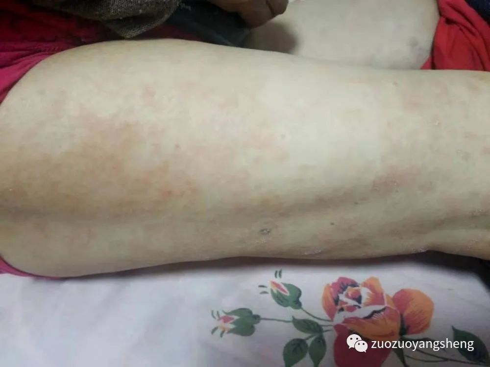 微问答207期:植物人状态,具体按推哪些原始点?如何使用热源? 微问答207期:植物人状态,具体按推哪些原始点?如何使用热源?