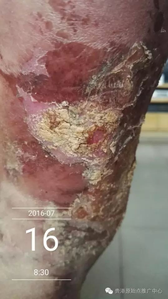 案例分享:原始点调理车祸烧伤不留疤的案例 案例分享:原始点调理车祸烧伤不留疤的案例