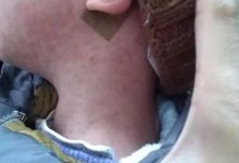 案例分享:原始点调理小朋友的婴幼儿急疹案例-原始点全球同学网