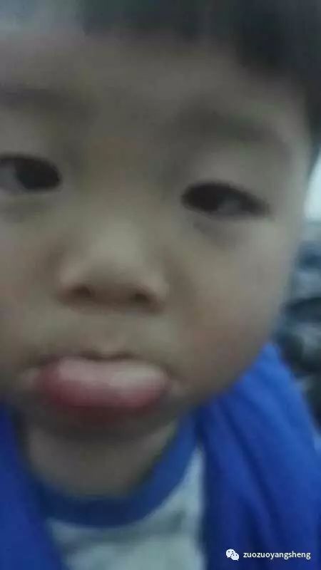 案例分享:原始点调理小朋友吃寒凉水果而嘴唇红肿的案例 案例分享:原始点调理小朋友吃寒凉水果而嘴唇红肿的案例