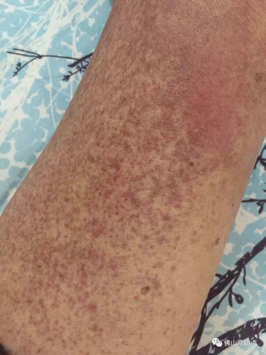 原始点调理肺肿瘤案例 原始点调理肺肿瘤案例