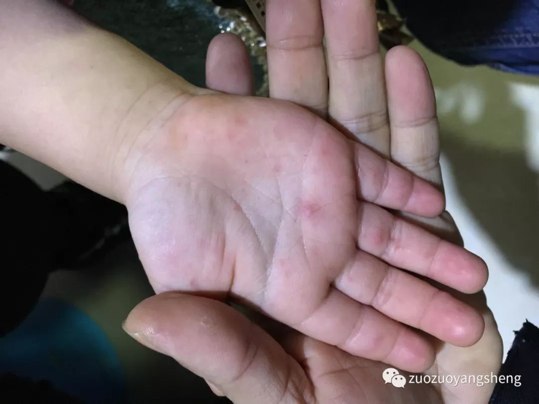案例分享:原始点调理宝宝手足口病的案例 案例分享:原始点调理宝宝手足口病的案例