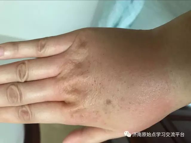 案例分享:巨痒湿疹案例 案例分享:巨痒湿疹案例