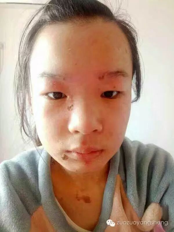 案例分享:原始点调理花季少女面部烫伤不留疤的案例 案例分享:原始点调理花季少女面部烫伤不留疤的案例
