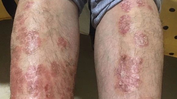 案例分享：原始点调理十几年牛皮癣的案例 刘章群   湖北恩施人  29岁-原始点全球同学网