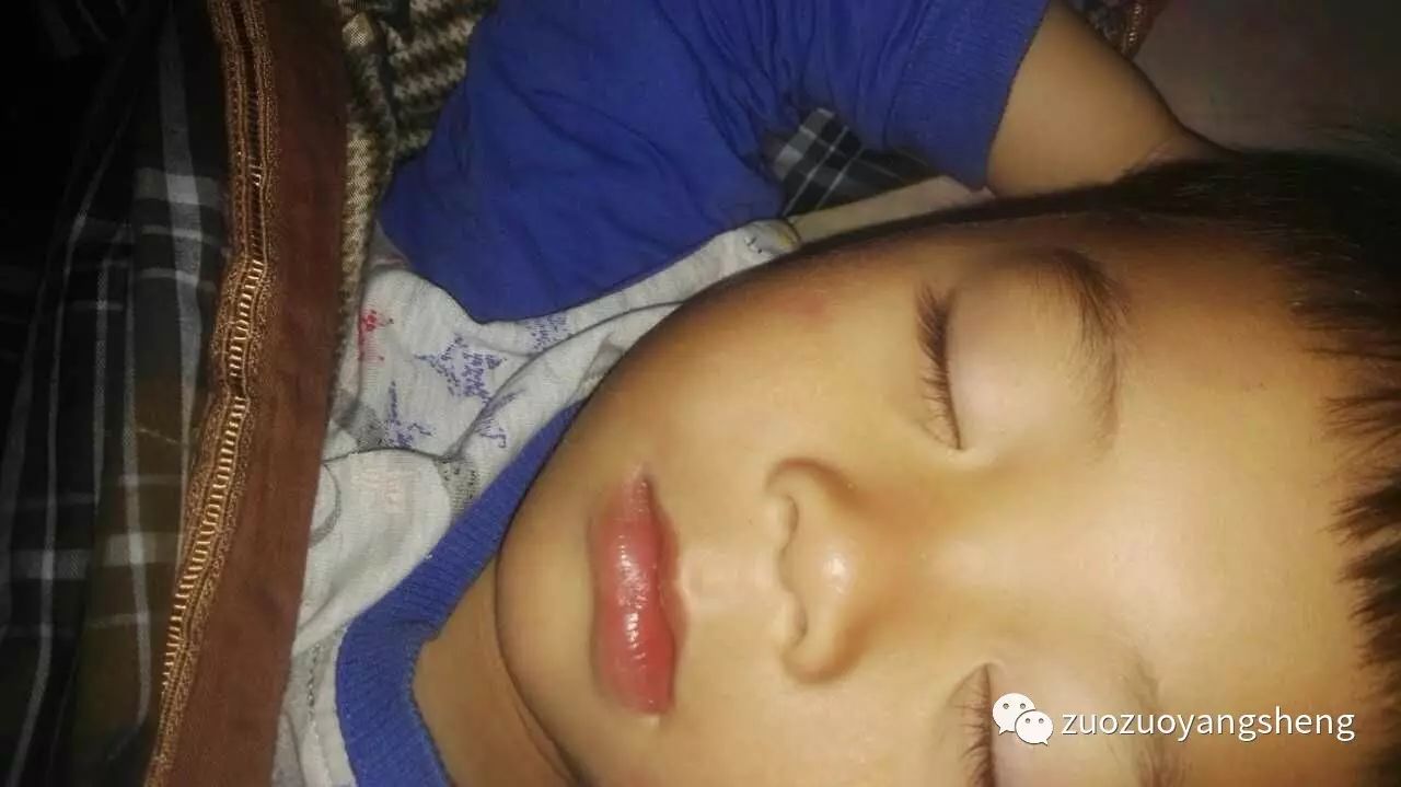 案例分享:原始点调理小朋友吃寒凉水果而嘴唇红肿的案例 案例分享:原始点调理小朋友吃寒凉水果而嘴唇红肿的案例