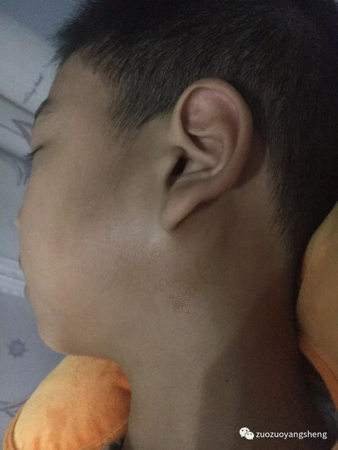 案例分享：原始点调理儿子的腮腺炎