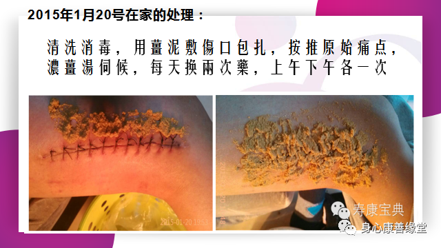 原始點:腿伤术后康复记 原始點:腿伤术后康复记