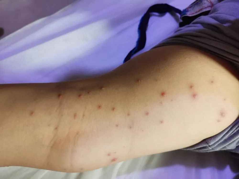 案例分享:原始点调理孩子水痘案例 案例分享:原始点调理孩子水痘案例