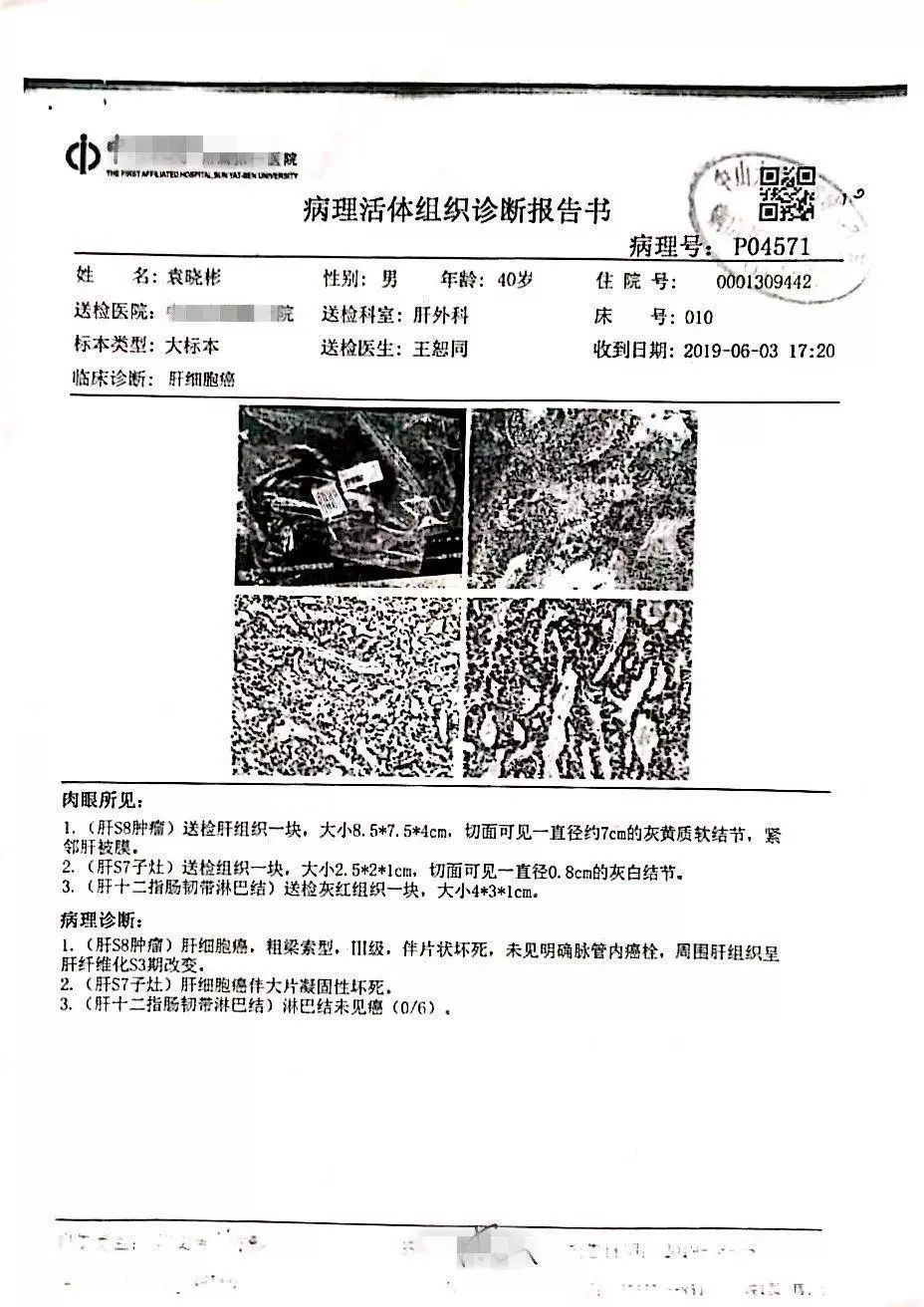原始点调理肝肿瘤案例 原始点调理肝肿瘤案例
