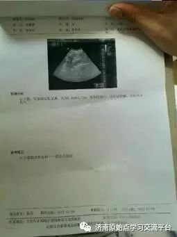 案例分享：原始点调理急性阑尾炎的案例