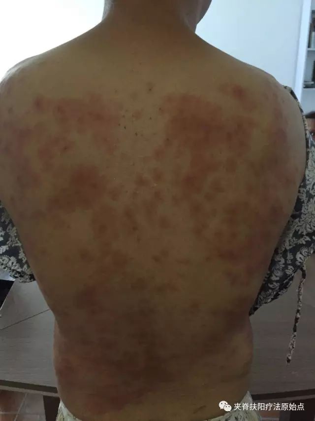 案例分享:原始点调理5年慢性荨麻疹 案例分享:原始点调理5年慢性荨麻疹