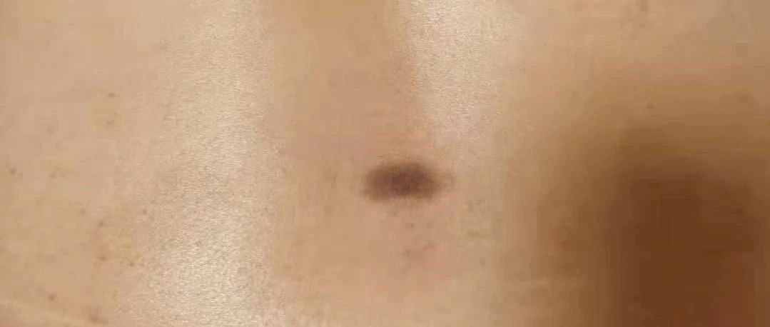 微问答200期：腰部命门穴位发黑怎么办？-原始点全球同学网