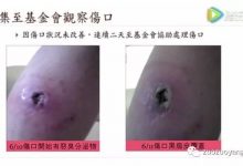 台湾基金会案例：原始点调理被狗咬伤案例-原始点全球同学网