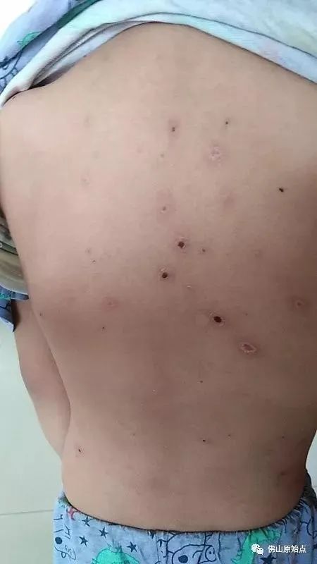 佛山原始点中心学员花开深圳:妈妈用原始点为七岁儿调理水痘9天康复案例 佛山原始点中心学员花开深圳:妈妈用原始点为七岁儿调理水痘9天康复案例