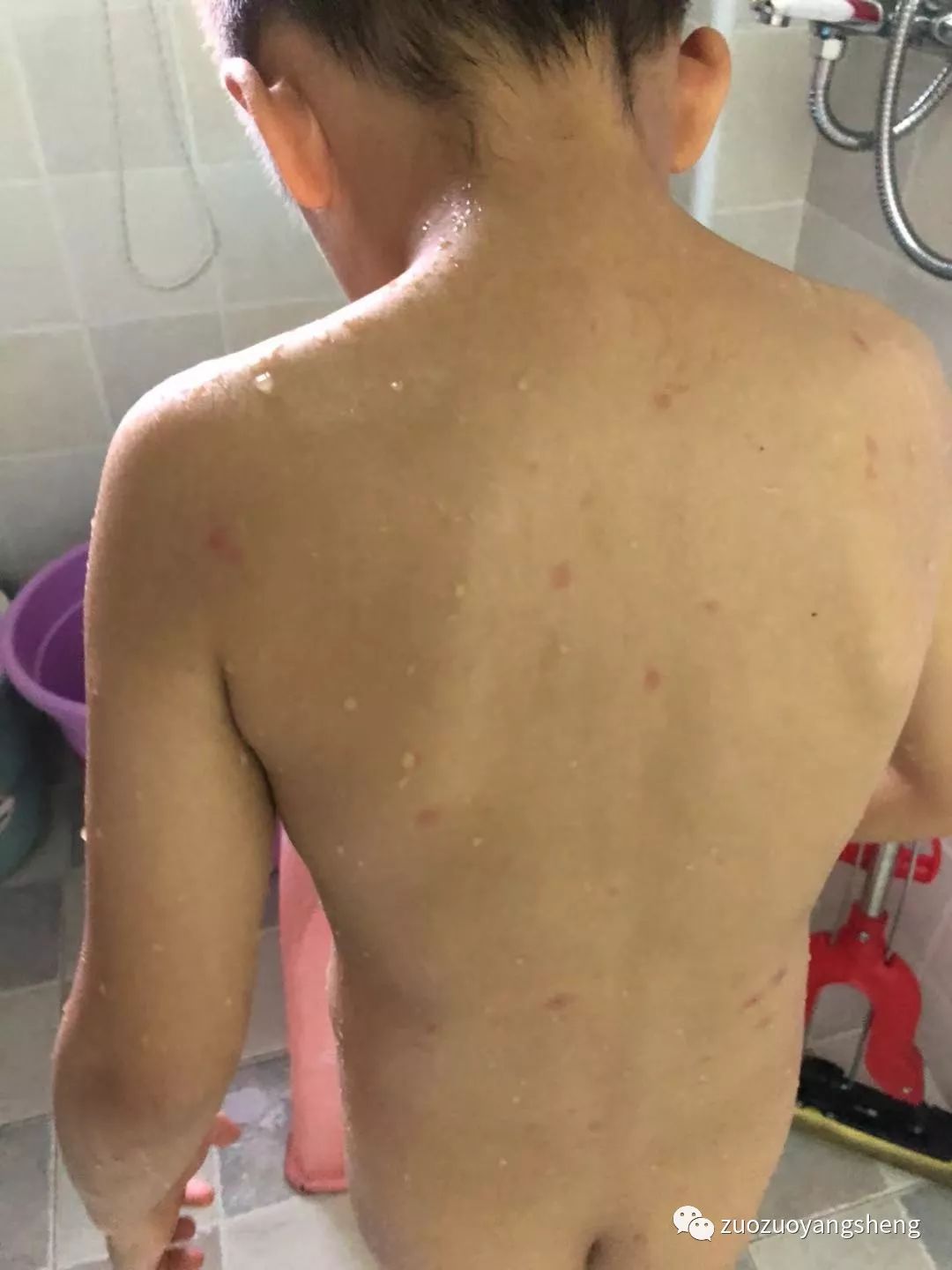 案例分享:原始点调理五岁小孩长水痘案例 案例分享:原始点调理五岁小孩长水痘案例