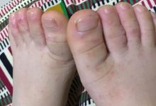 案例分享:原始点调理宝宝手足口病的案例-原始点全球同学网