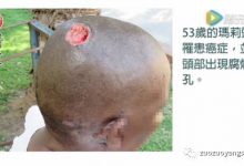 台湾基金会案例:头部溃烂穿孔案例(非洲津巴布韦)-原始点全球同学网