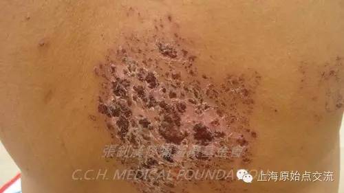 案例分享:原始点调理带状疱疹的案例 案例分享:原始点调理带状疱疹的案例