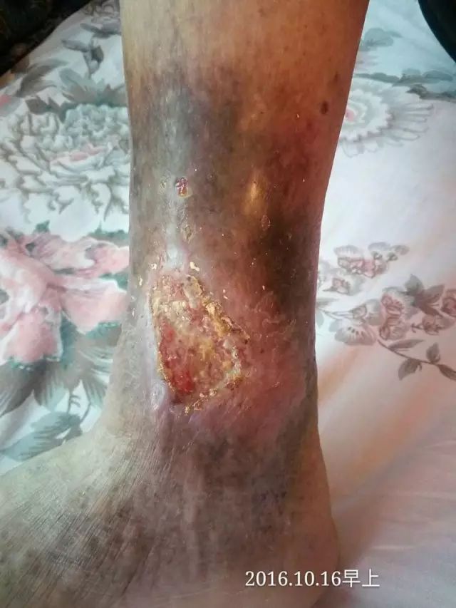 案例分享：原始点调理20年伤口不愈合的案例