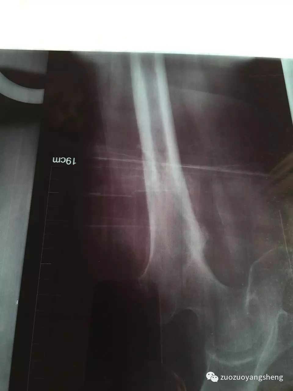 原始点续写又一奇迹：83岁婆婆骨折错位没开刀没手术，6周康复