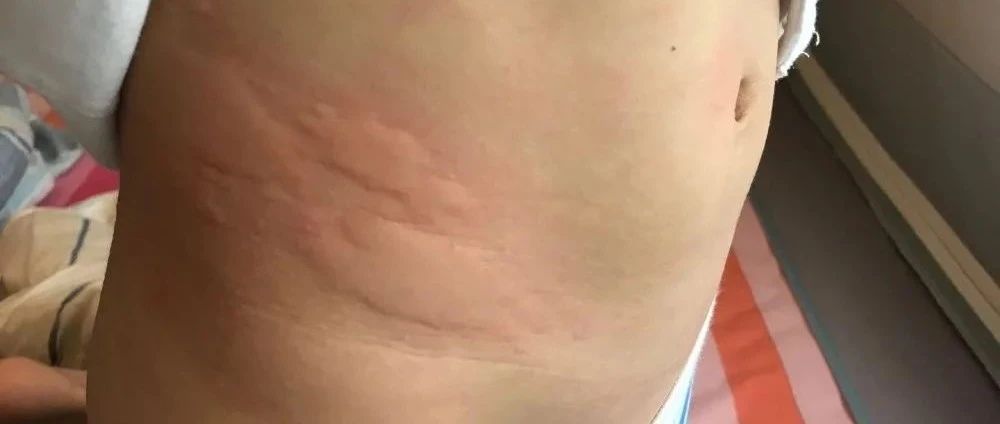 案例分享：原始点调理小孩疑似荨麻疹的案例-原始点全球同学网
