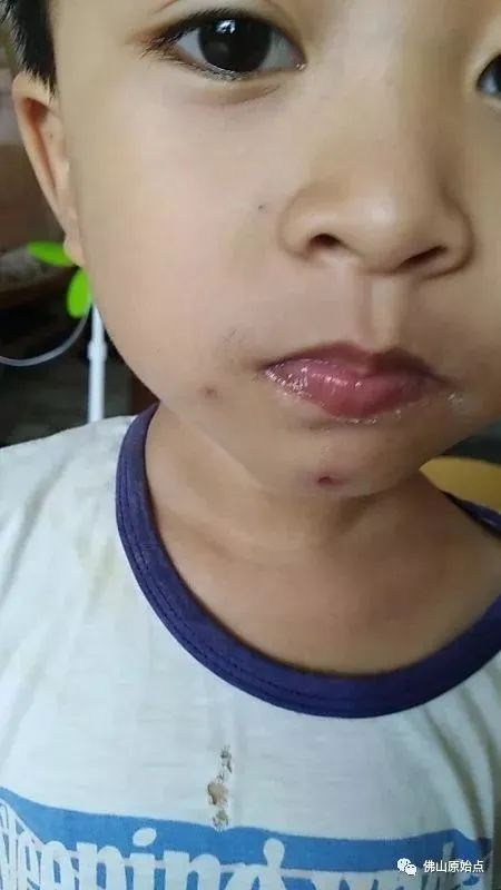 佛山原始点中心学员花开深圳:妈妈用原始点为七岁儿调理水痘9天康复案例 佛山原始点中心学员花开深圳:妈妈用原始点为七岁儿调理水痘9天康复案例