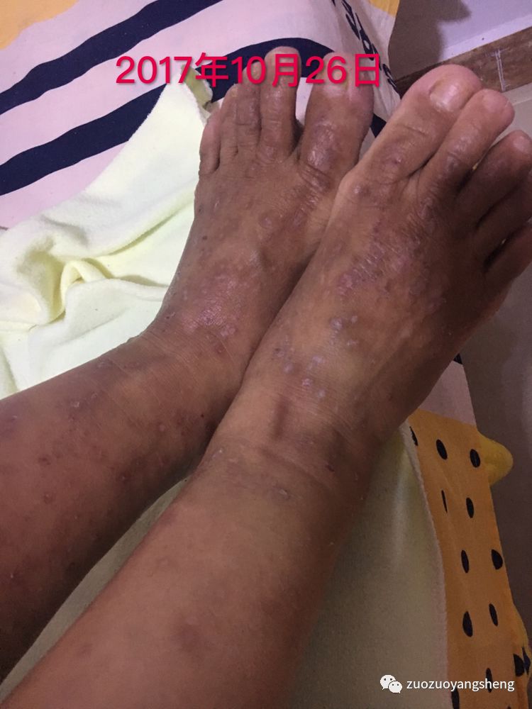 案例分享:原始点调理全身奇痒无比的湿疹案例 案例分享:原始点调理全身奇痒无比的湿疹案例