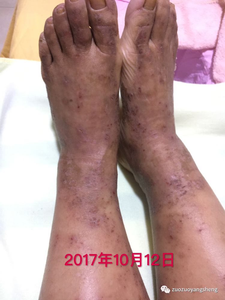 案例分享:原始点调理全身奇痒无比的湿疹案例 案例分享:原始点调理全身奇痒无比的湿疹案例
