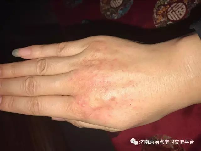 案例分享:巨痒湿疹案例 案例分享:巨痒湿疹案例
