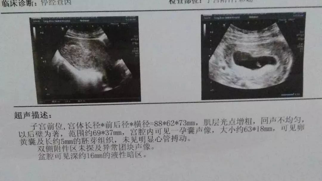 坚持原始点调理，43天排出死胎的案例-原始点全球同学网